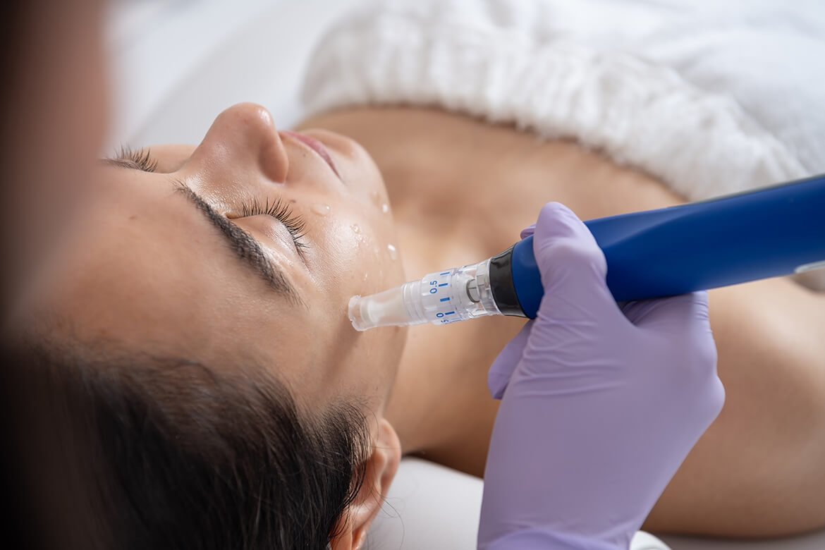 Microneedling with PRP